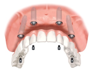 all-on-4-implant